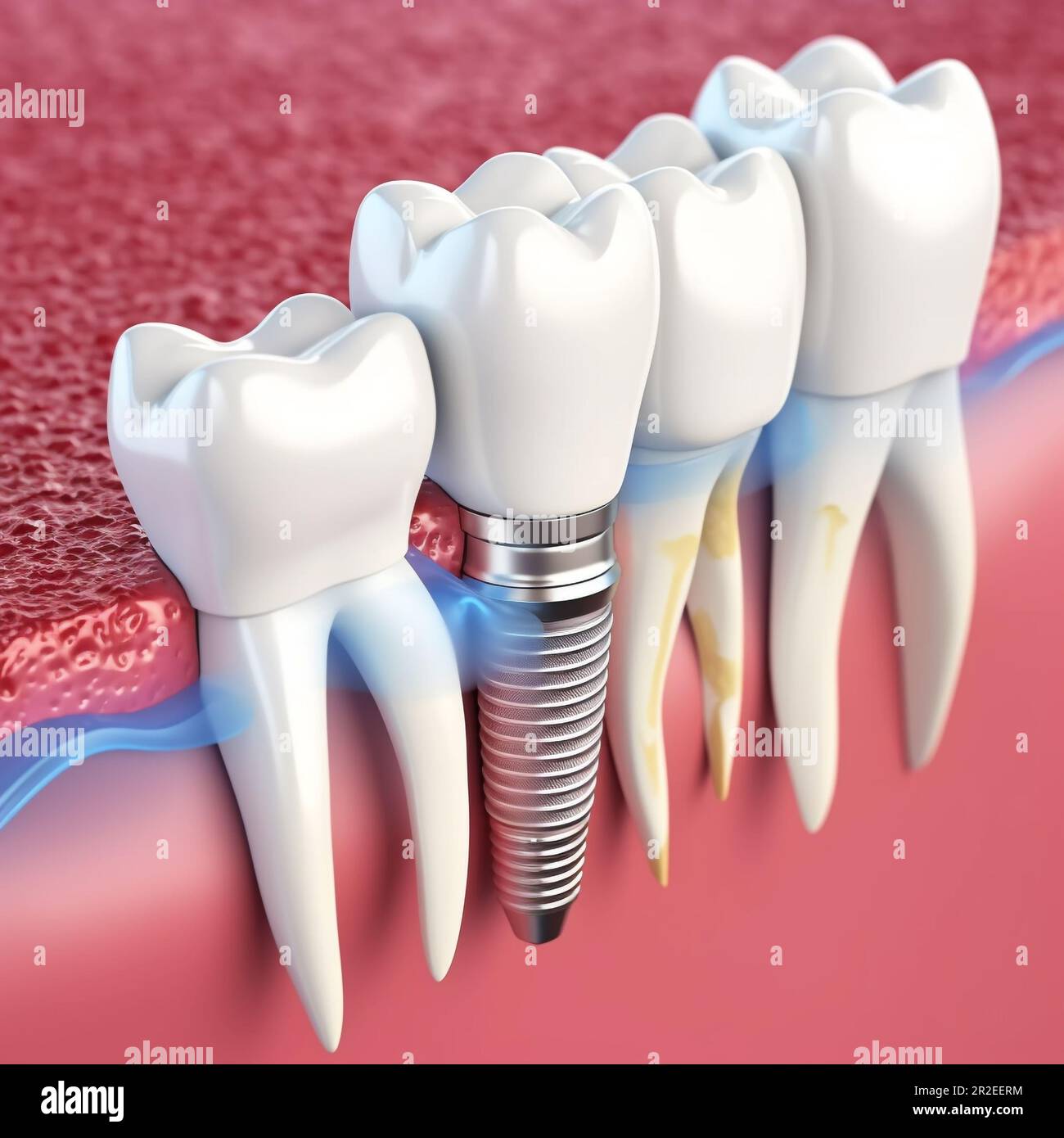 Dental teeth implant insert to gum. 3D rendering Stock Photo Alamy