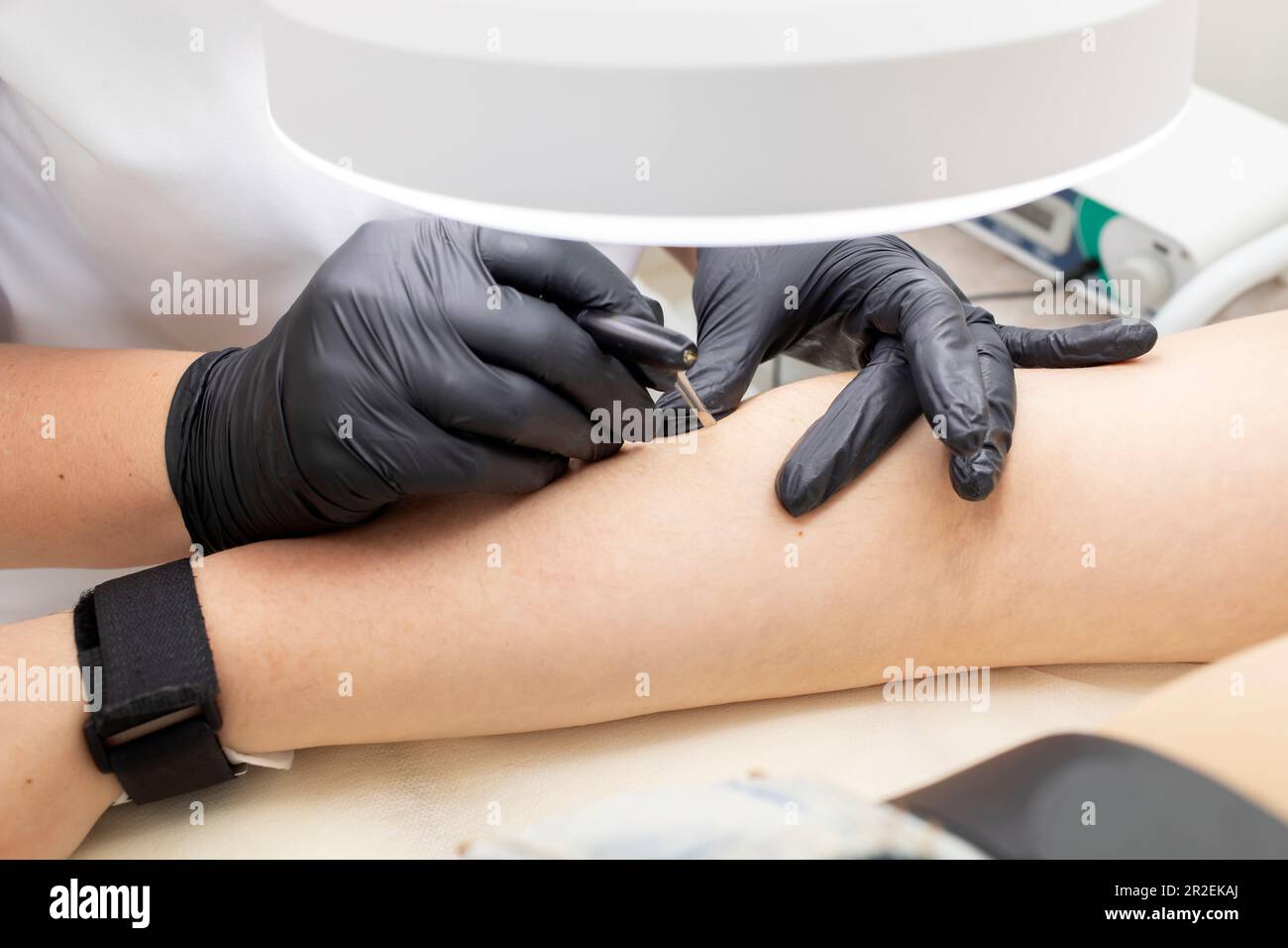 Hirsutism, Closeup Hair Removal Process With Electrolysis On Hand Of White Young Woman, Electric Epilation In Beauty Salon. Horizontal Plane Stock Photo