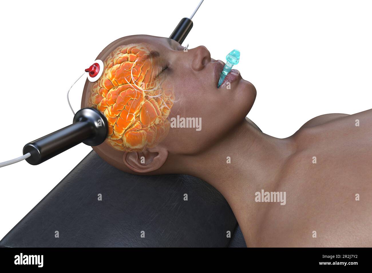 Electroconvulsive therapy, illustration Stock Photo - Alamy