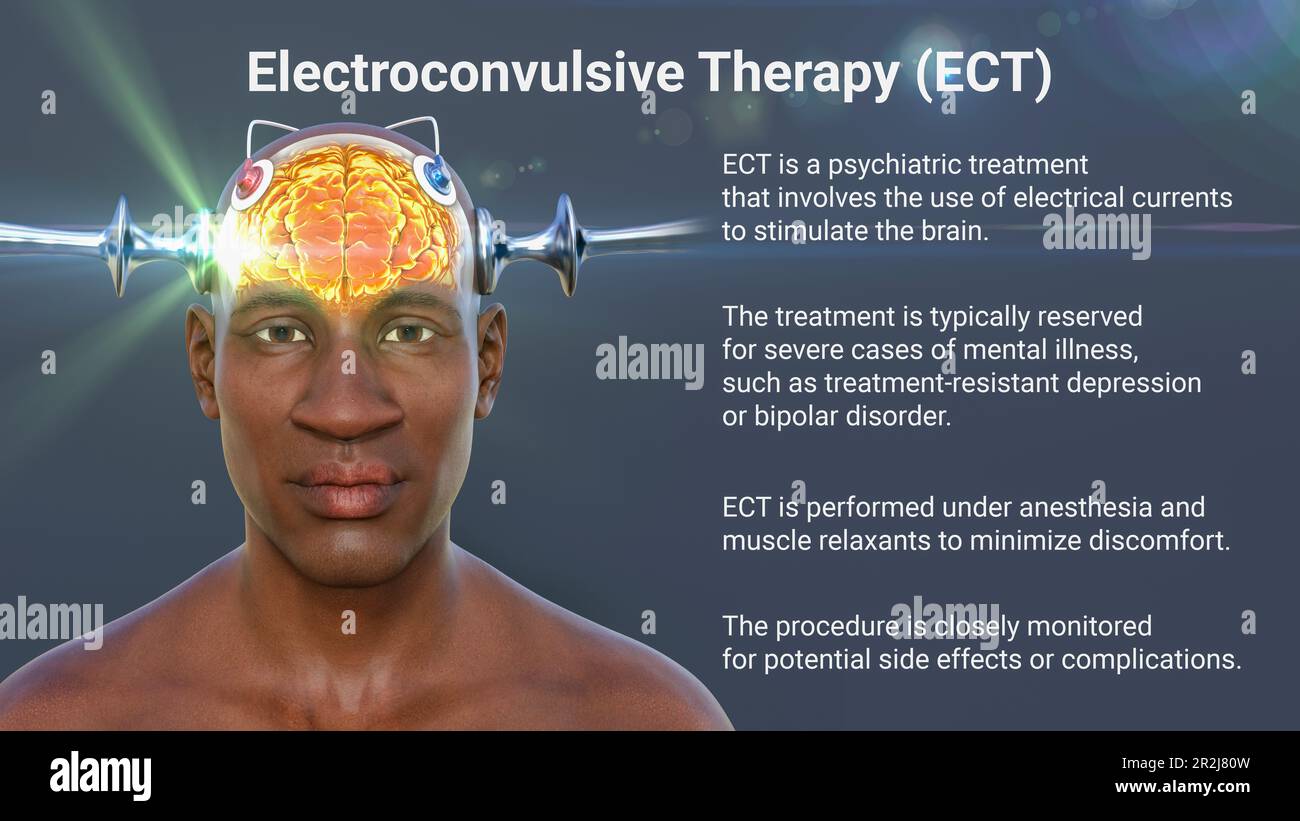 Electroconvulsive therapy, illustration Stock Photo - Alamy