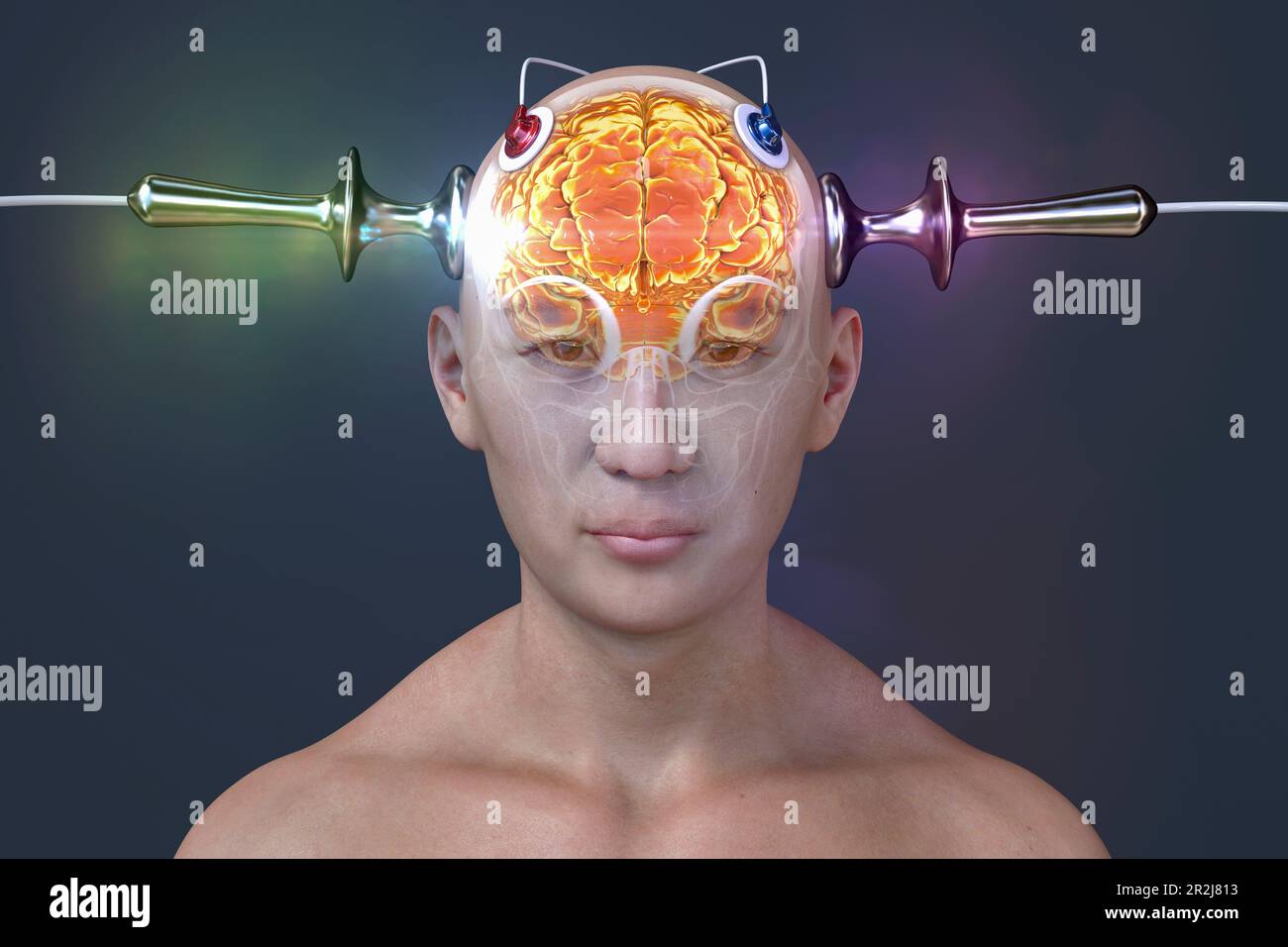 Electro convulsive therapy hi-res stock photography and images - Alamy