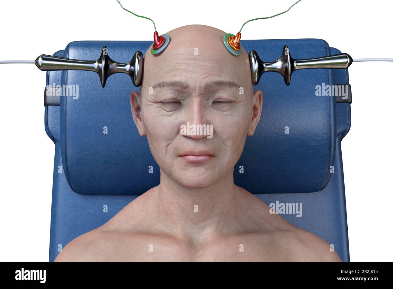 Electroconvulsive therapy, illustration Stock Photo - Alamy