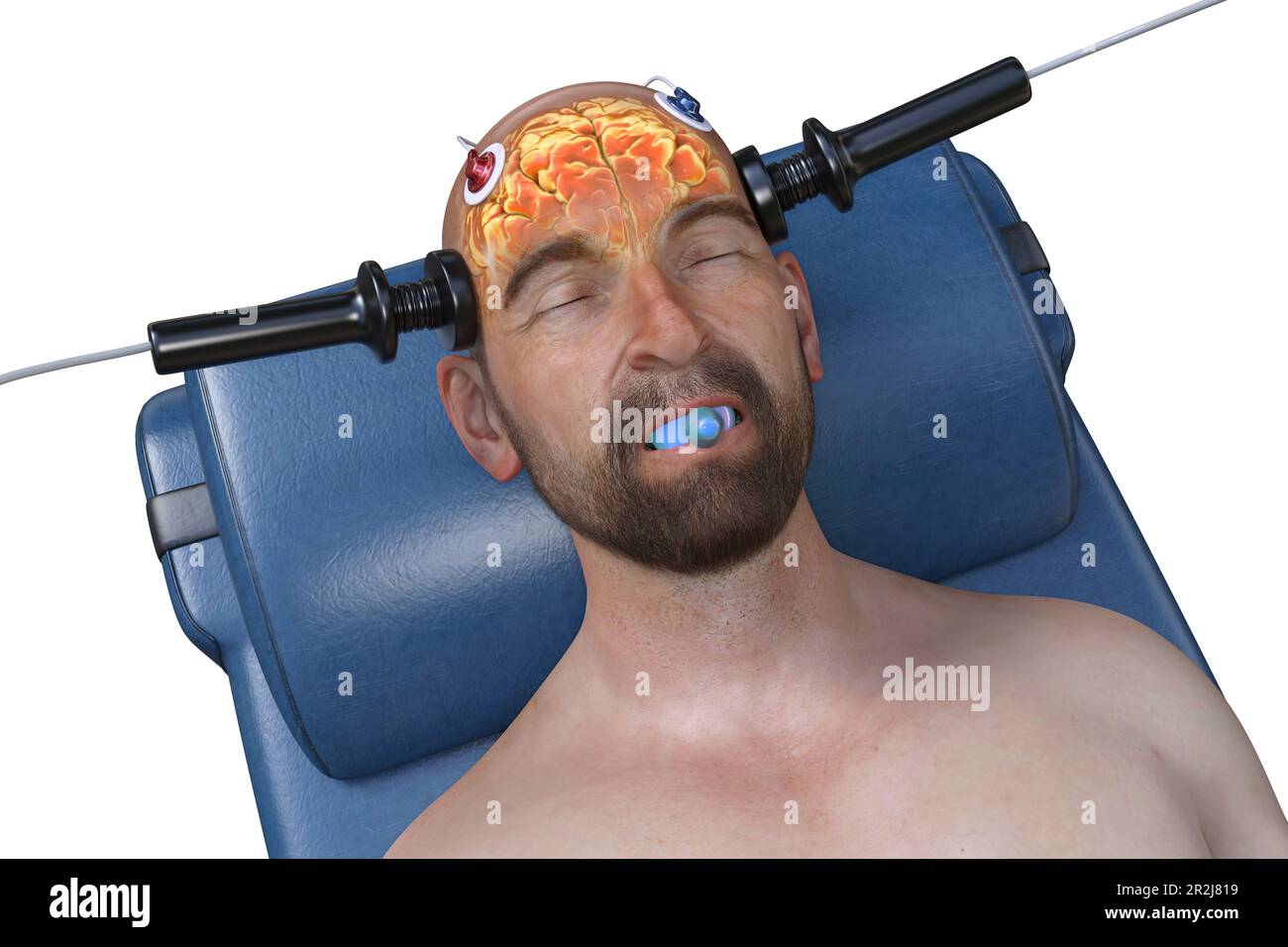 Electroconvulsive therapy, illustration Stock Photo