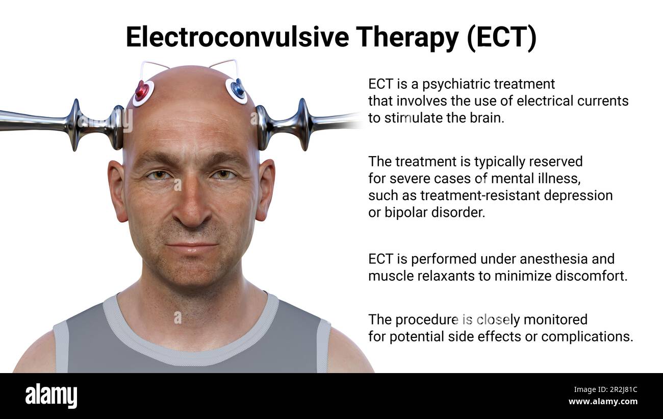 Electroconvulsive therapy, illustration Stock Photo - Alamy