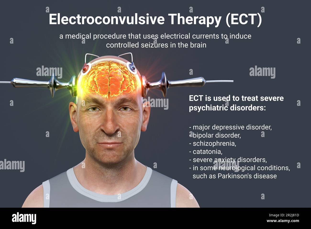 Electroconvulsive therapy, illustration Stock Photo - Alamy