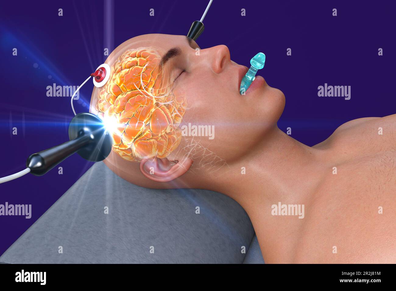 Electro convulsive therapy hi-res stock photography and images - Alamy