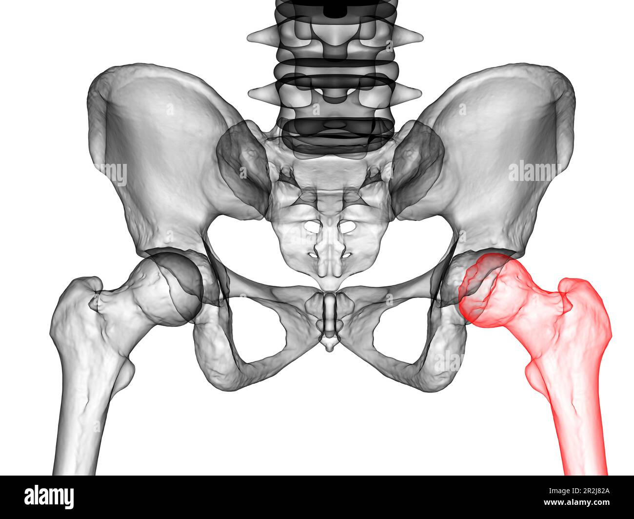 Legg-Calve-Perthes disease, illustration Stock Photo - Alamy, image size:1300x1064