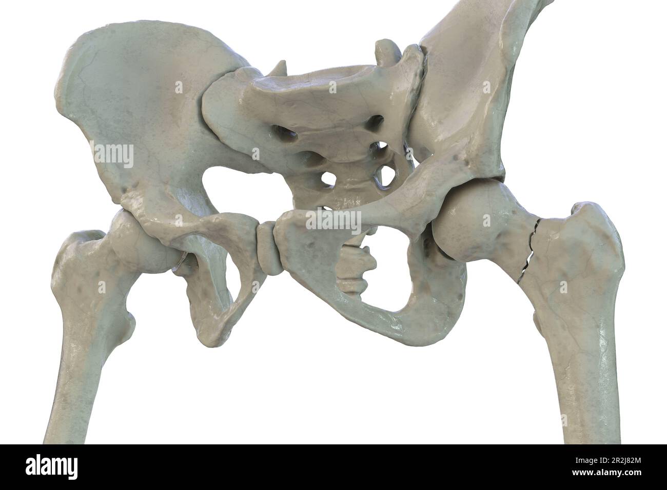 Fracture of the femur neck, illustration Stock Photo