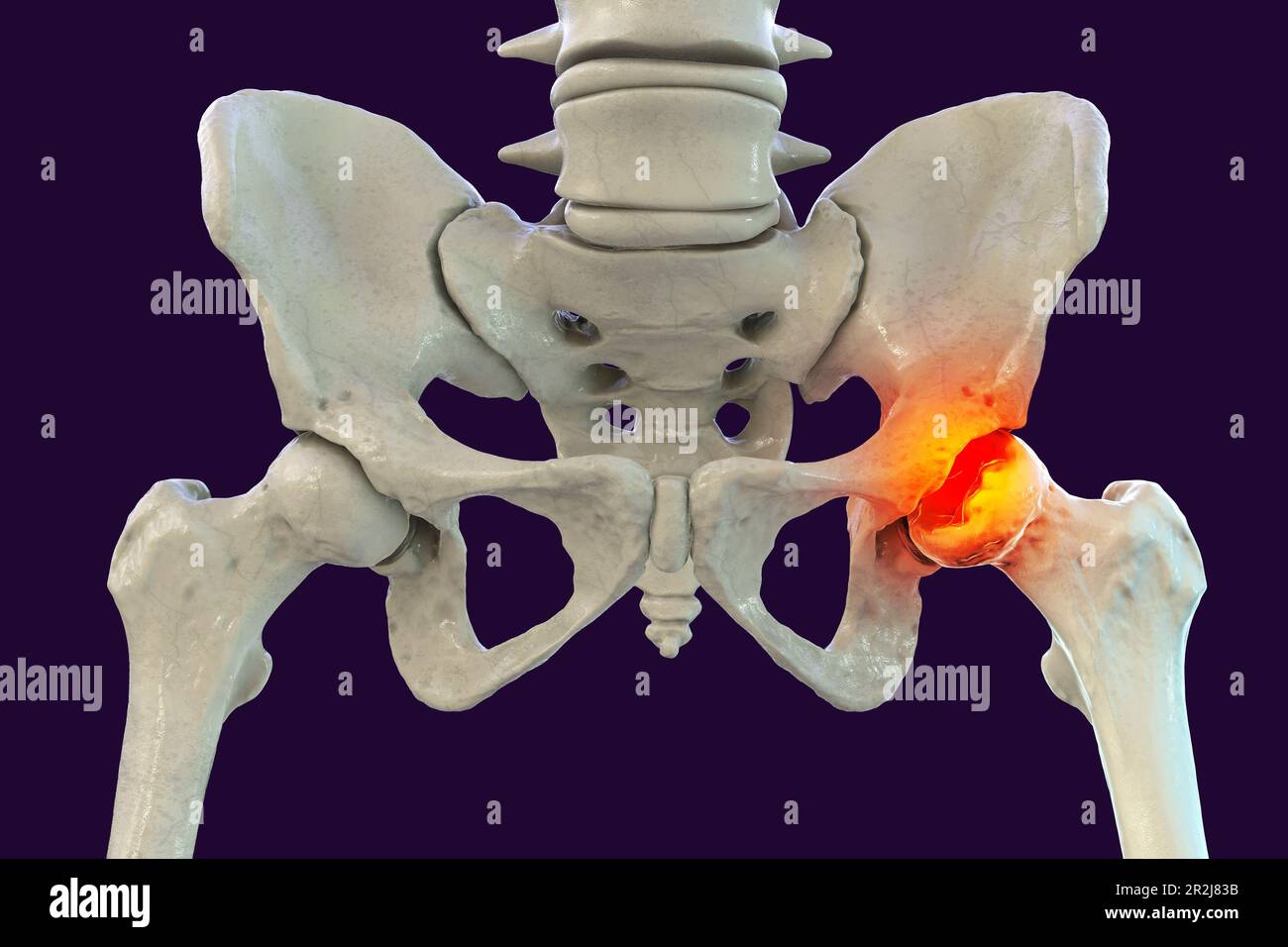 Legg-Calve-Perthes Disease is an idiopathic avascular necrosis of the  proximal femoral epiphysis in children. Diagnosis can be suspected with hip  radiographs. MRI may be required for diagnosis of occult or early disease., image size:1300x956