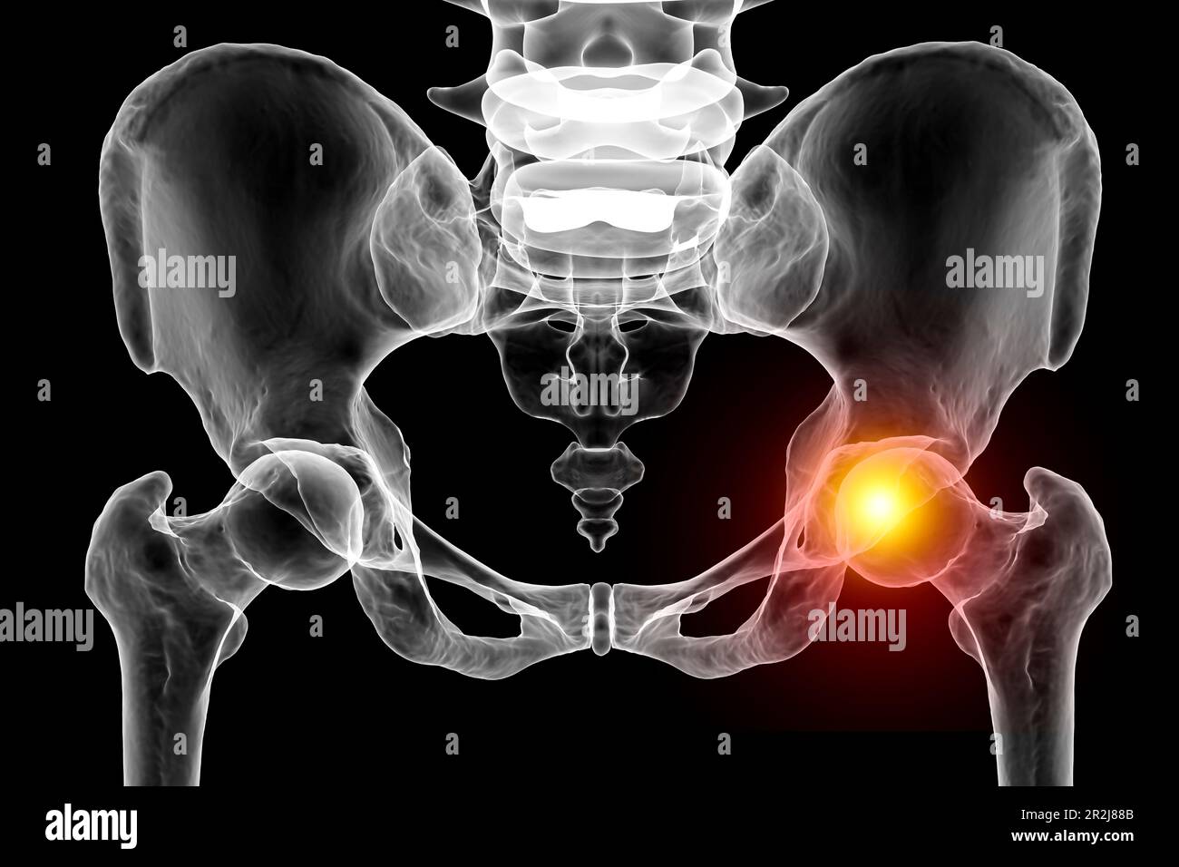 Hip joint pain. Computer illustration depicting the pelvis and femur bones with the femur head