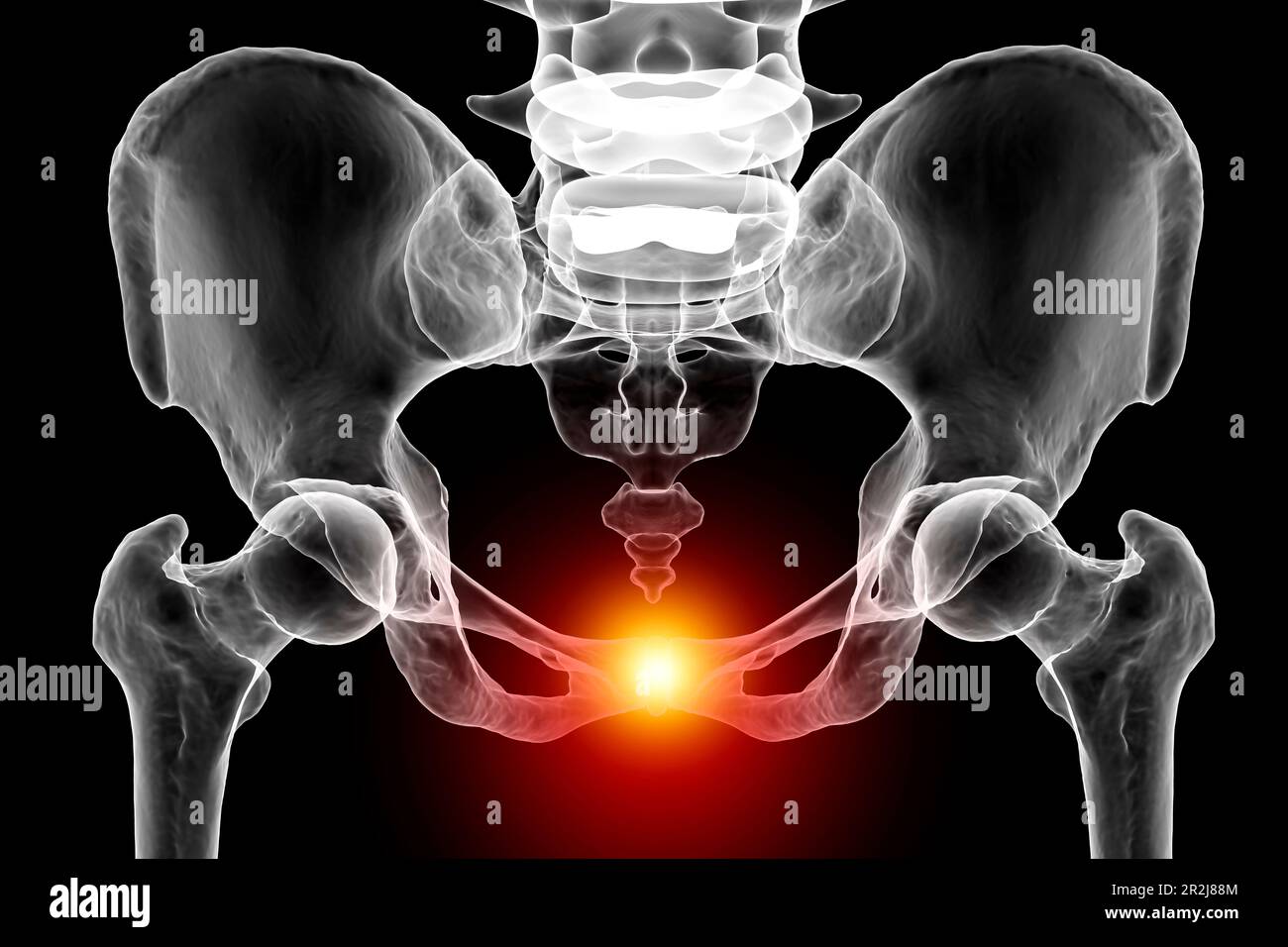 Symphysis pubis dysfunction, illustration Stock Photo - Alamy