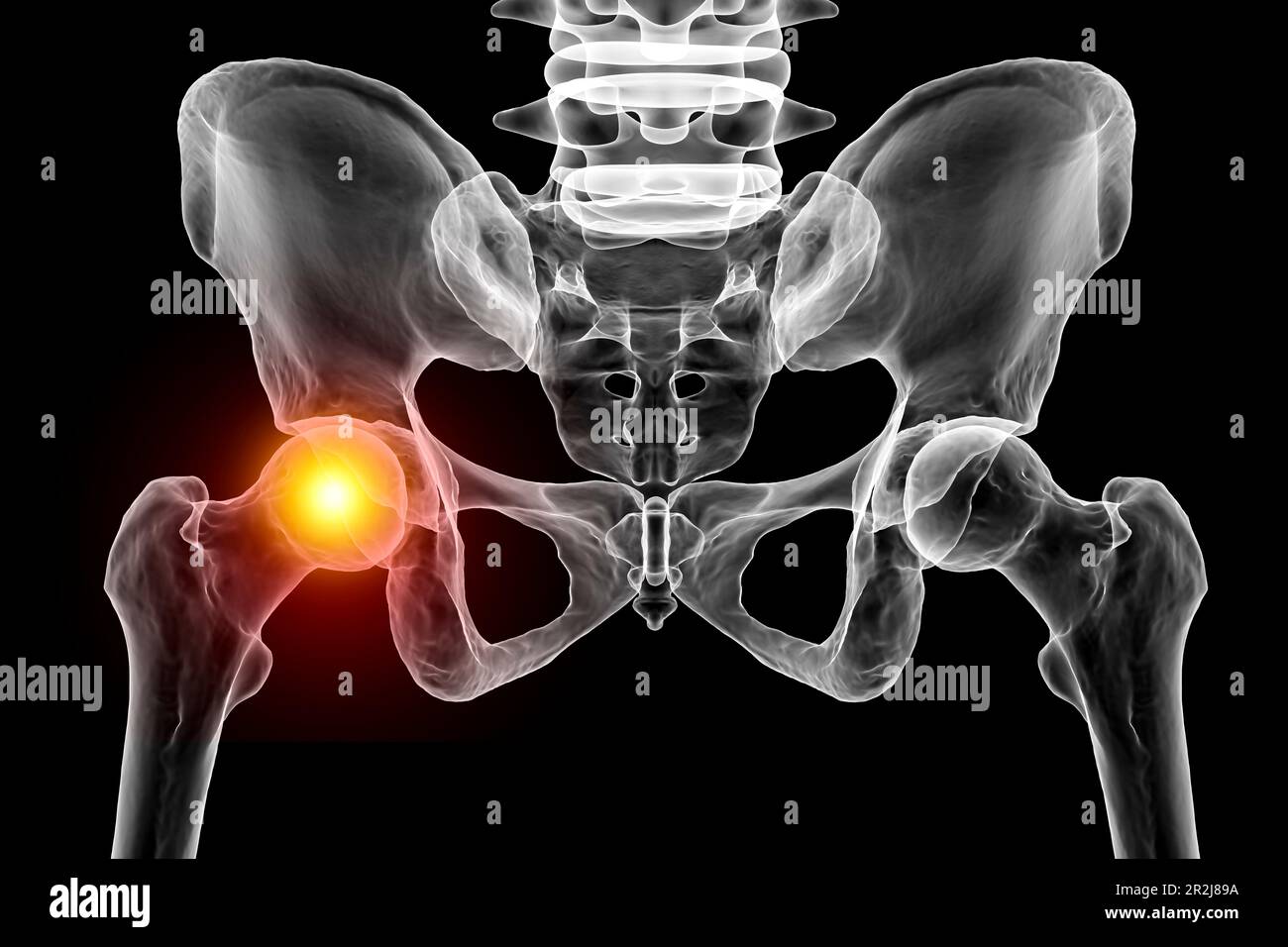 Hip joint pain, conceptual illustration Stock Photo