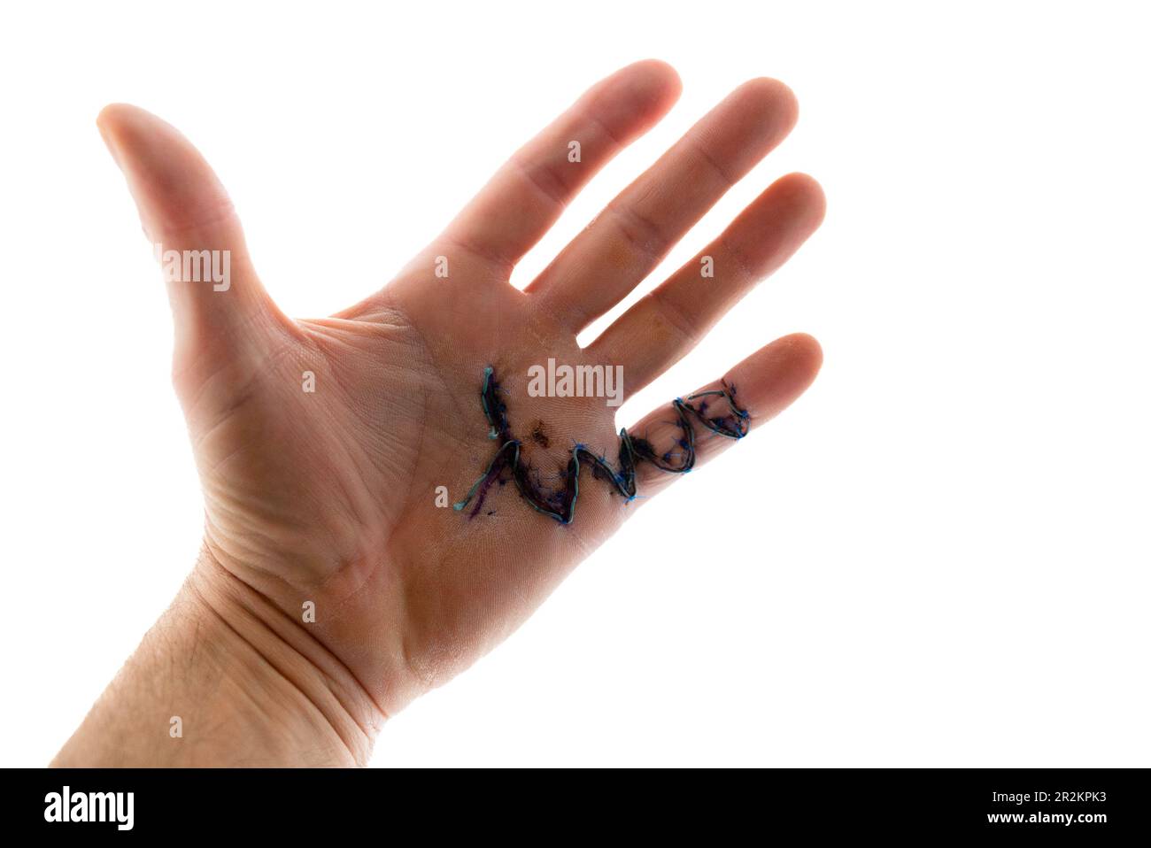 A horizontal close-up view of a caucausian male hand with stitches after Morbus Dupuytren surgery Stock Photo