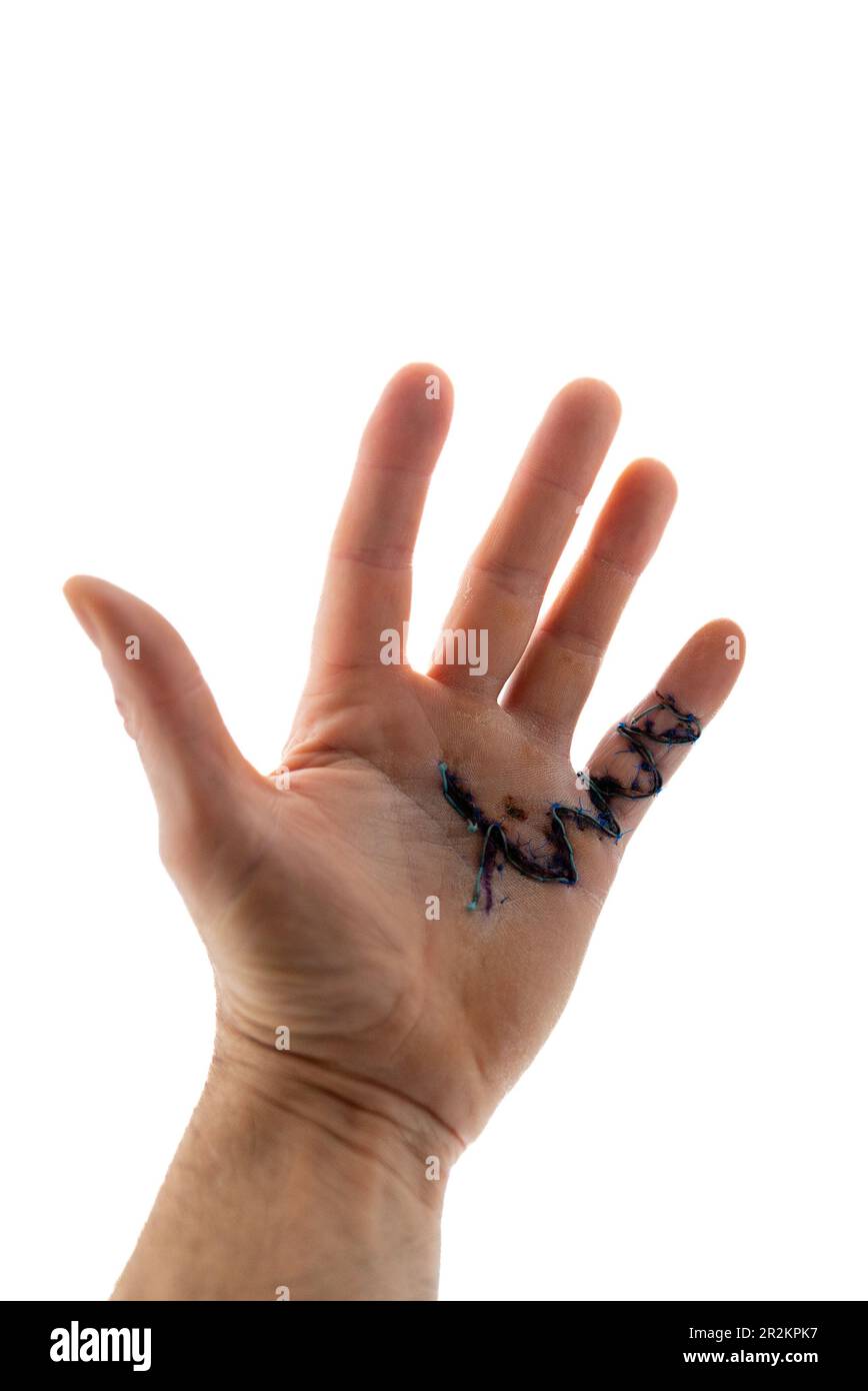 A vertical close-up view of a caucausian male hand with stitches after Morbus Dupuytren surgery Stock Photo