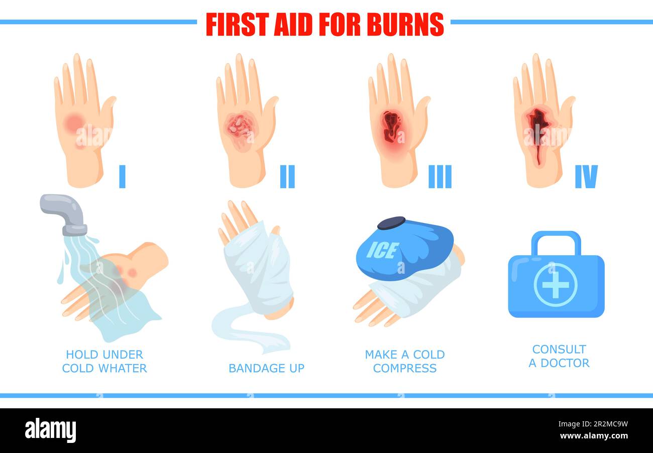 Ways of healing different skin burn injuries Stock Vector Image & Art