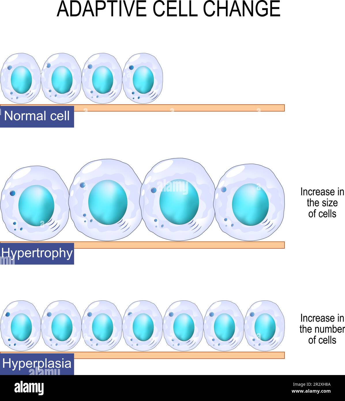 adaptive cell change. Normal cell, hypertrophy is an increase in the size of cells, and hyperplasia -increase in the number of cells. Vector Poster Stock Vector