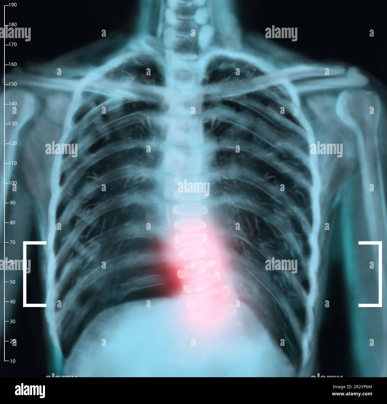 X-ray of human spine showing curvature. Patient suffering from scoliosis Stock Photo