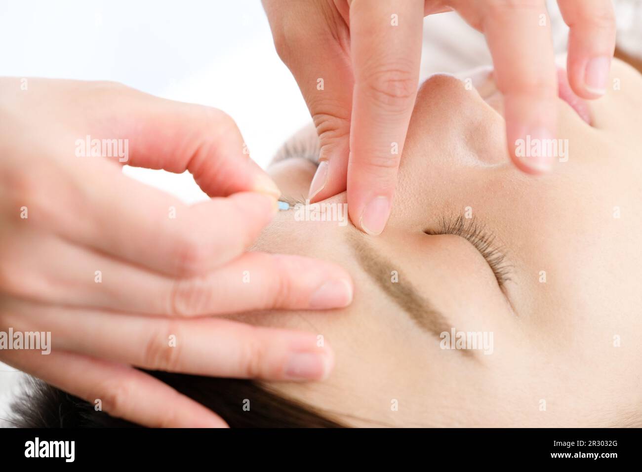 Close-up of a woman and her practitioner's hands being given acupuncture needles on her face in an acupuncture clinic. Stock Photo