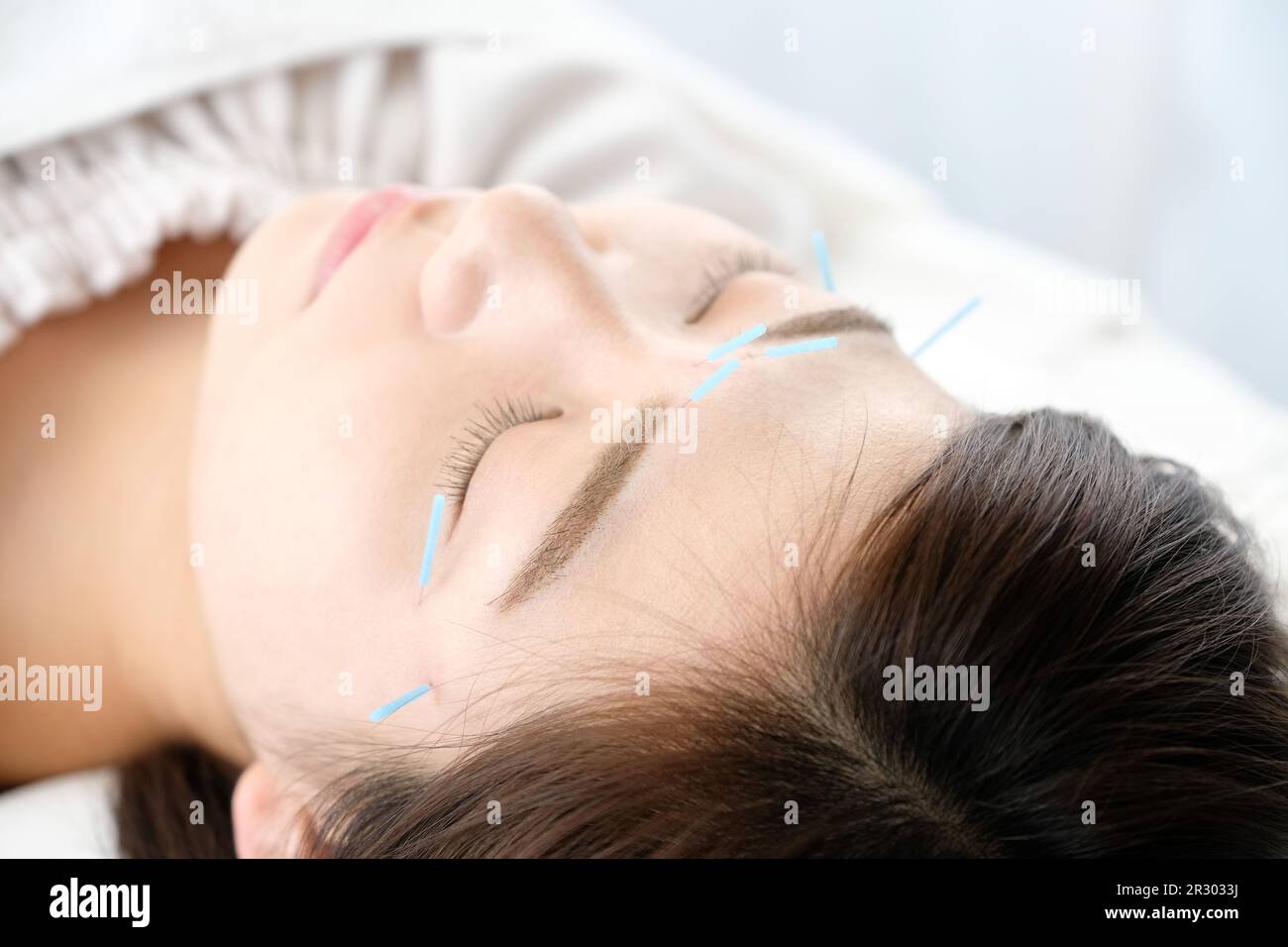 Up of a woman getting acupuncture on her face at an acupuncture clinic