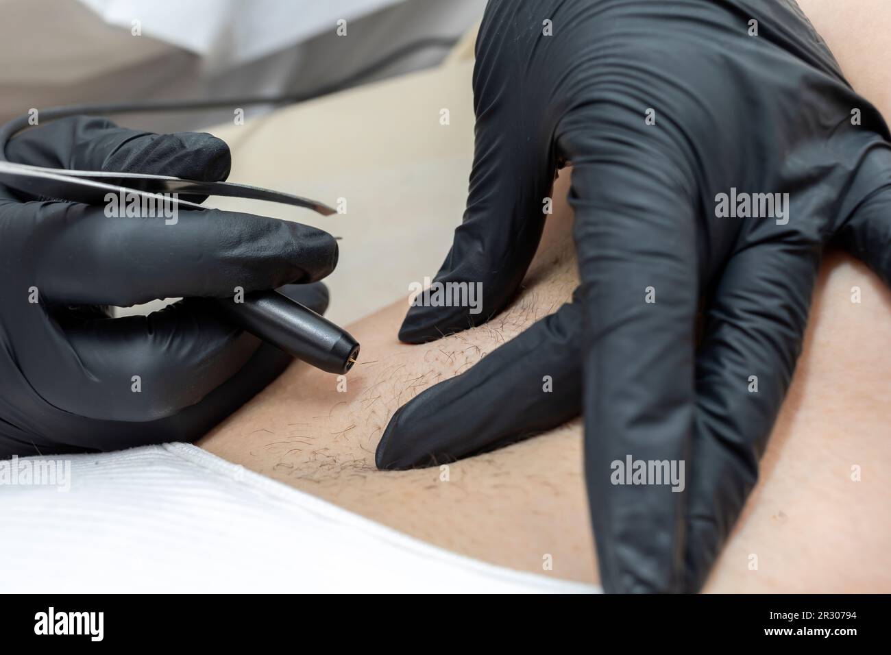 Epilation Radiology Closeup Dermatologist Removing Patient's Armpit Hair With Electrolysis ...