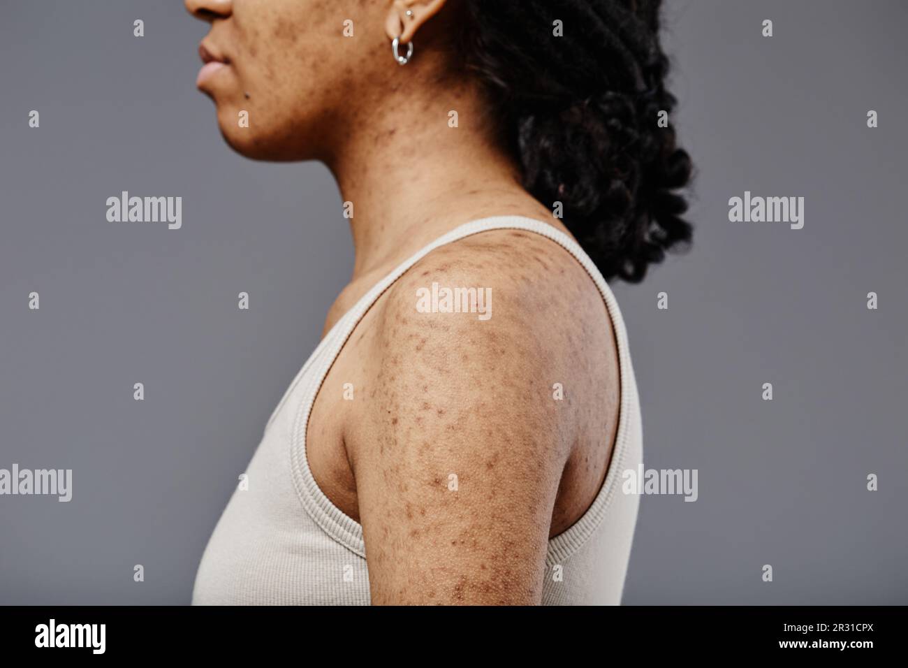 Closeup side view of black young woman with real skin texture and acne