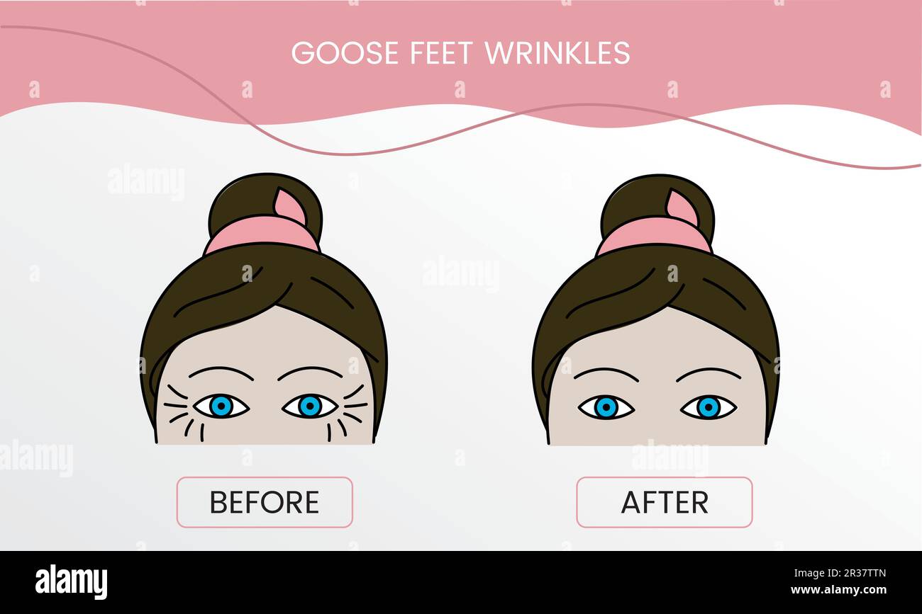 Goose feet wrinkles, laser cosmetology before procedure and after