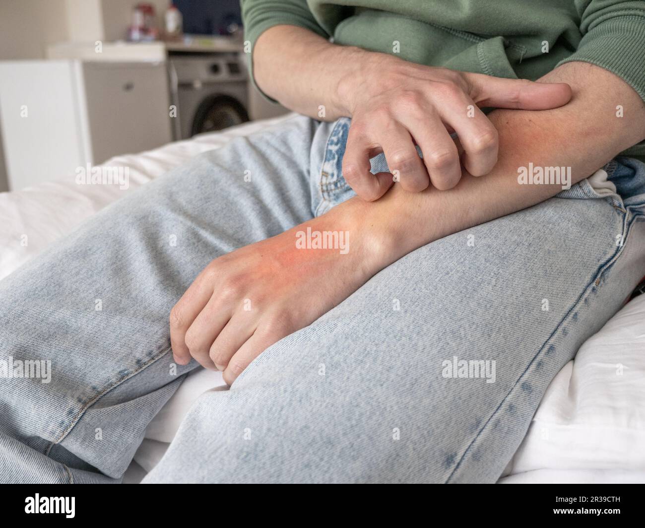 Man scratched his hand until red. Nervous disorders and mental health concept. Stock Photo