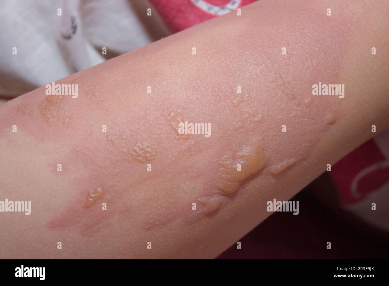 Burn skin child hires stock photography and images Alamy