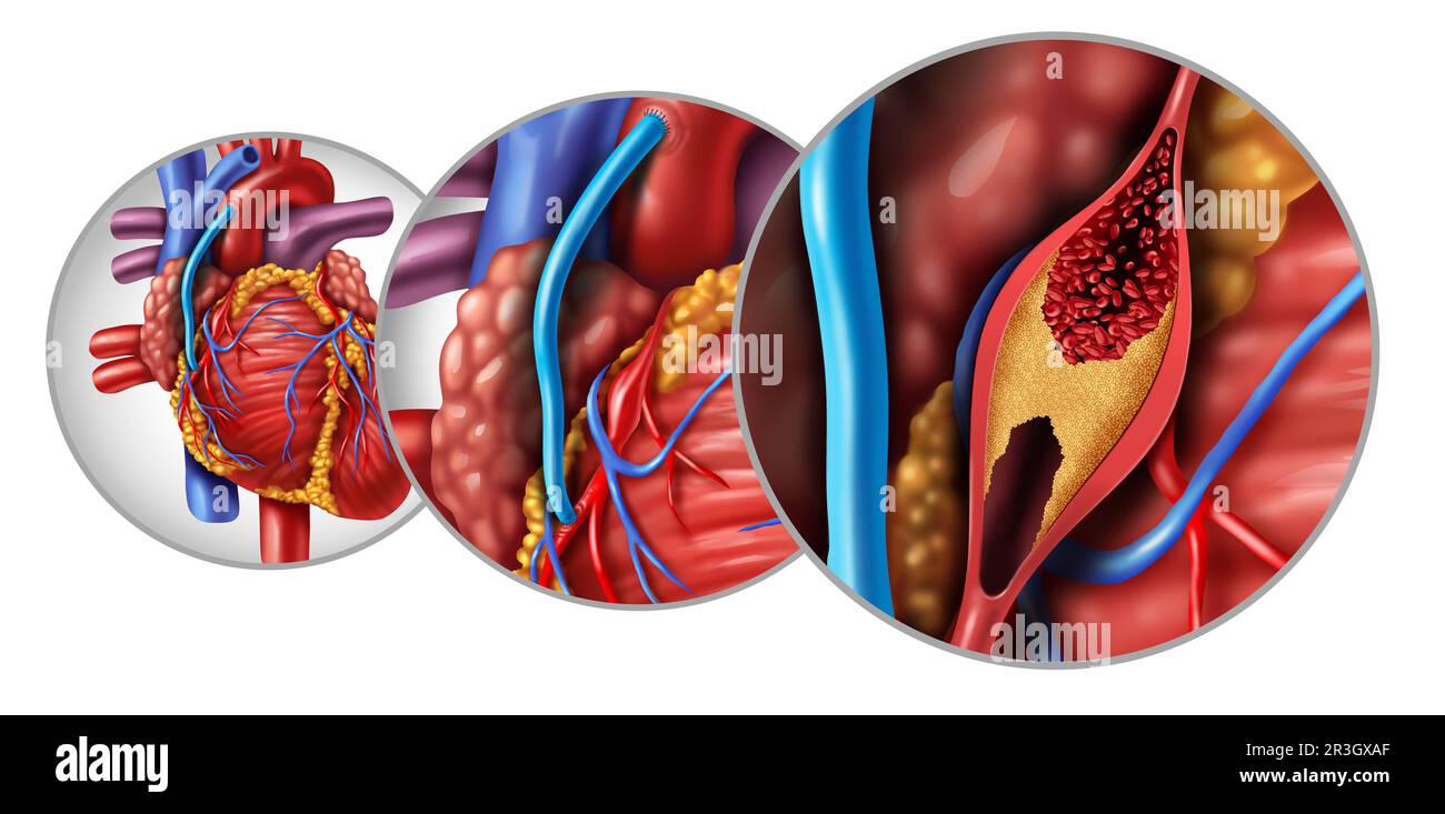 Bypass surgery and Coronary Artery Grafting or CABG as an obstruction