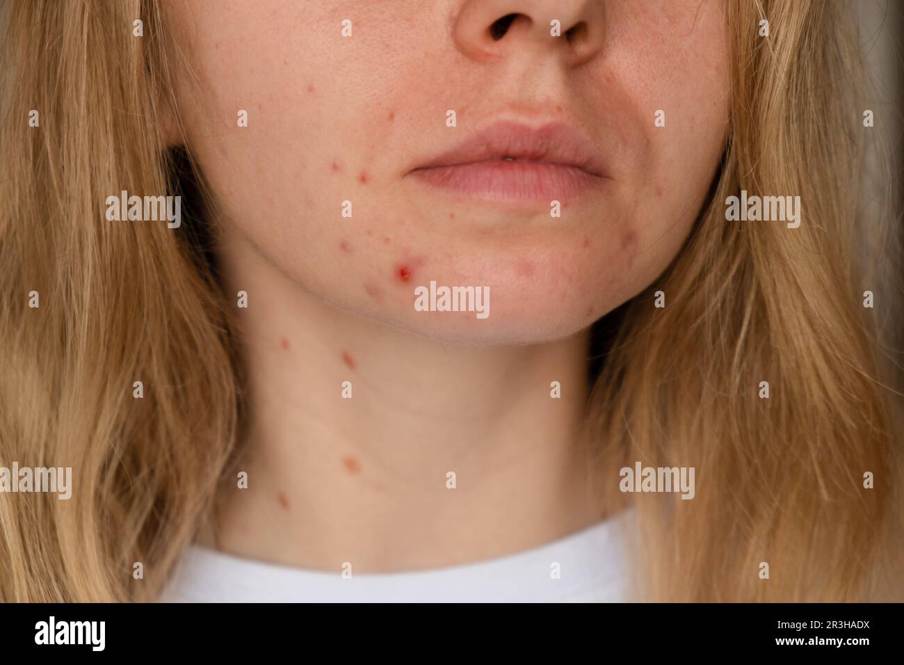 Unrecognizable woman showing her acne on face. Close-up acne on woman's face with rash skin ,scar and spot that allergic to cosm Stock Photo