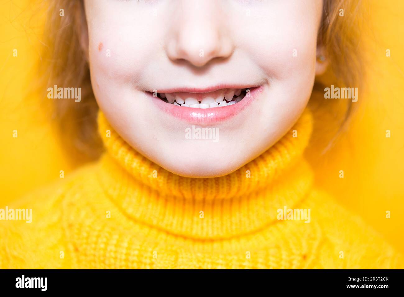 Girl shows her teeth-pathological bite, malocclusion, overbite. Pediatric dentistry and periodontics, bite correction. Health an Stock Photo