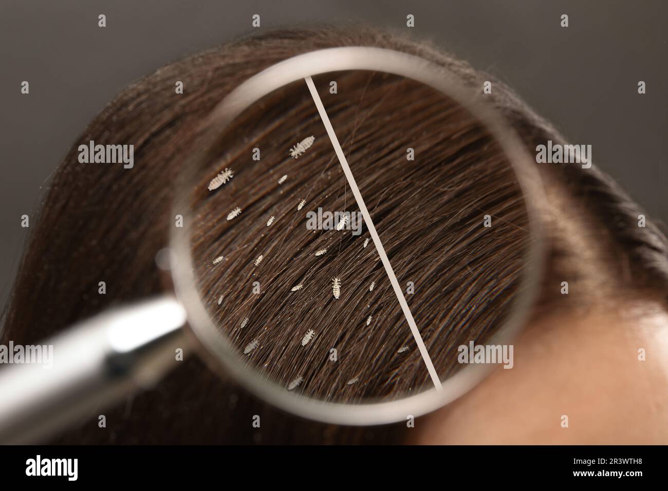 Collage showing woman's hair before and after lice treatment on grey background, closeup. View on parasitic insect through magnifying glass. Suffering Stock Photo
