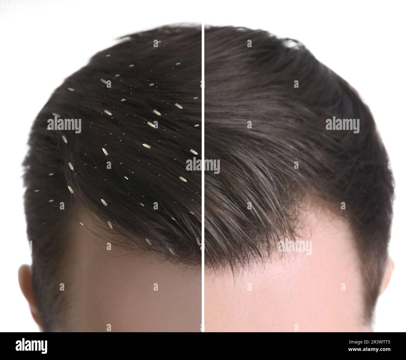 Collage showing man's hair before and after lice treatment on white background, closeup. Suffering from pediculosis Stock Photo