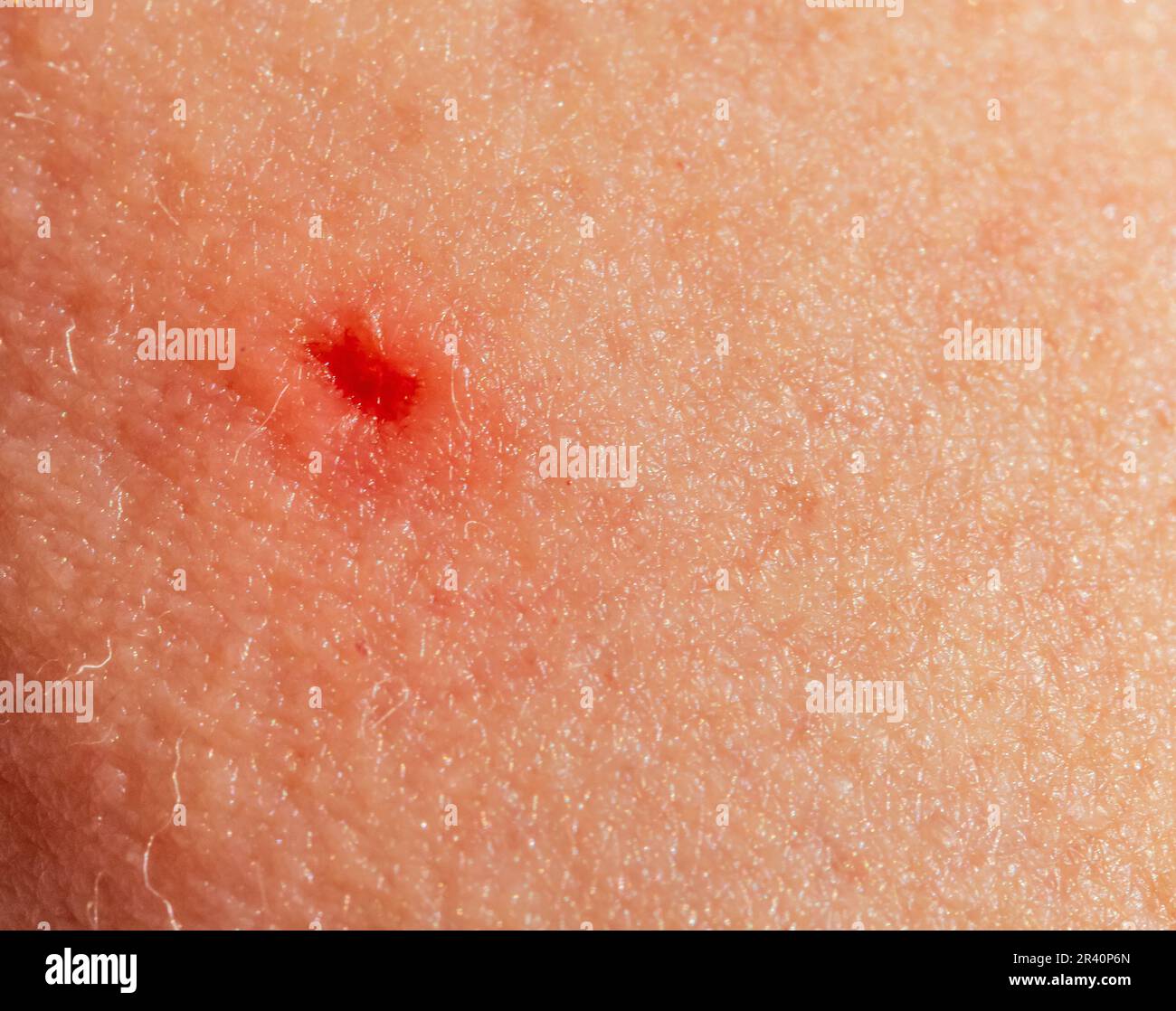 1,069 Spider Bite On Skin Images, Stock Photos, 3D objects, & Vectors