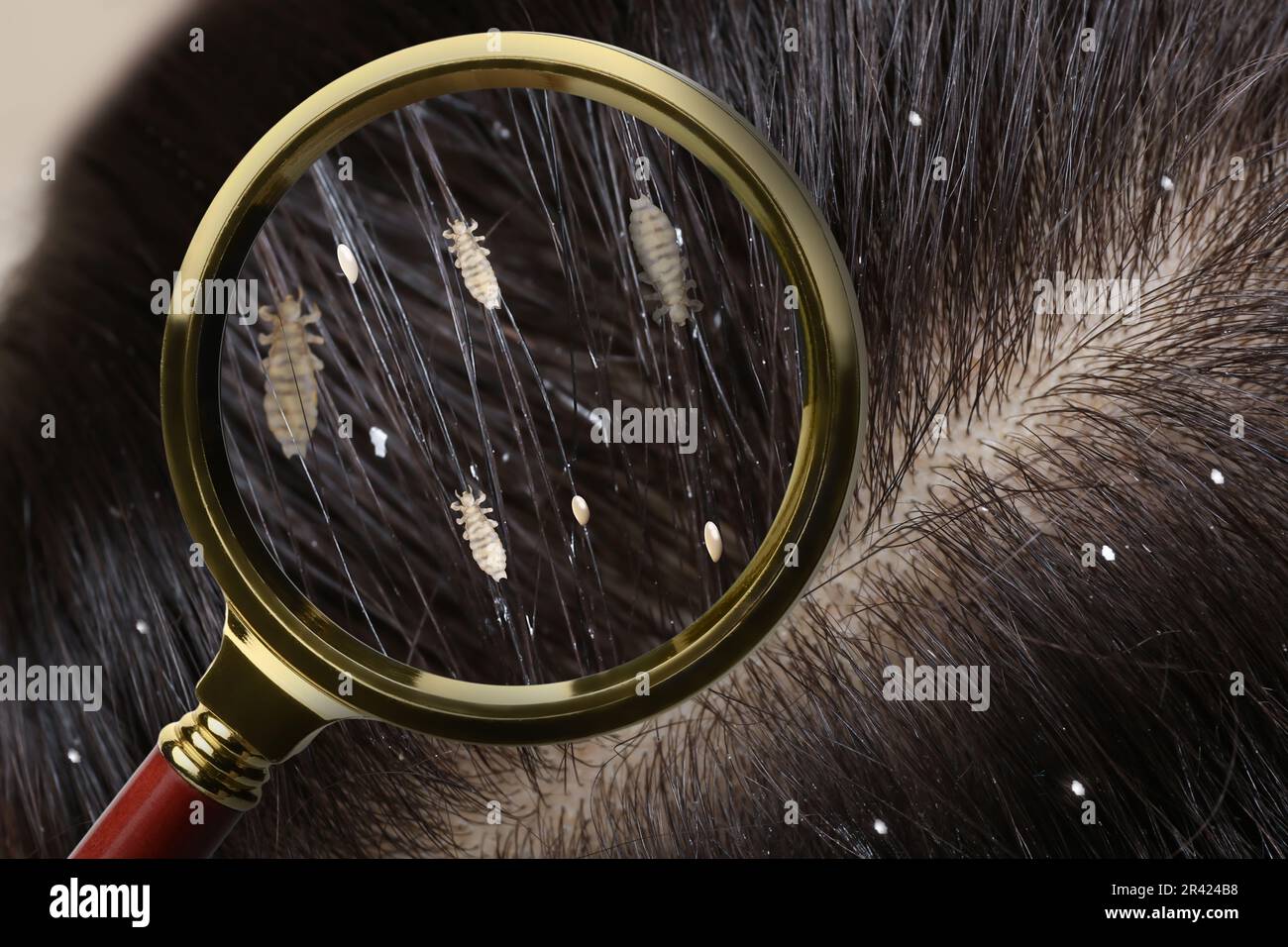 Pediculosis. Woman with lice and nits, closeup. View through magnifying glass on hair Stock Photo