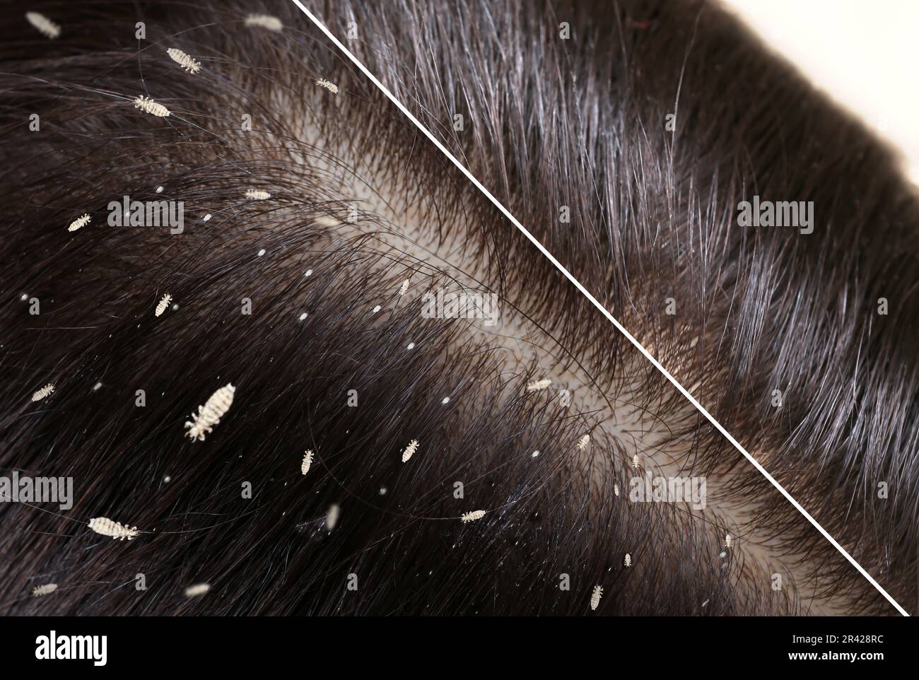 Collage showing woman's hair before and after lice treatment, closeup. Suffering from pediculosis Stock Photo