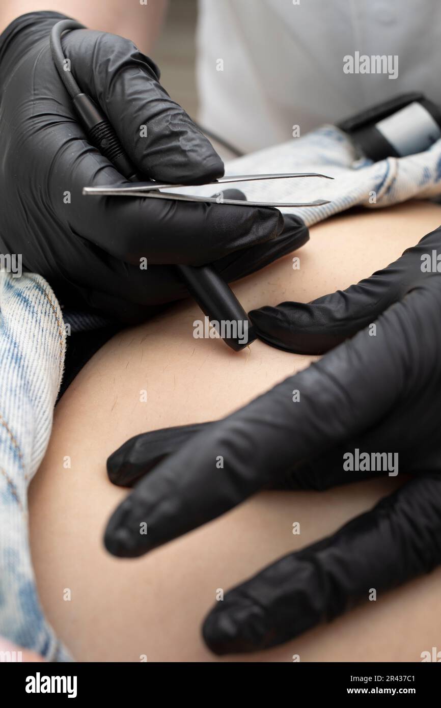 Cropped Dermatologist Removes Hair On Woman's Belly, Abdomen With Electrolysis Procedure, Electric Epilation In Beauty Salon. Vertical Plane Stock Photo