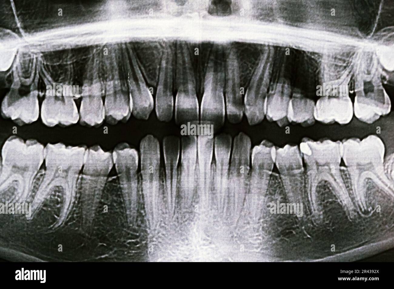 Panoramic Xray of the jaw. Xray of the teeth of a 12yearold girl