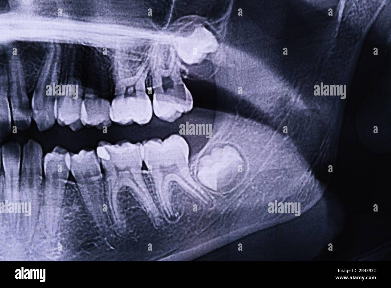 Panoramic Xray of the jaw. Xray of the teeth of a 12yearold girl