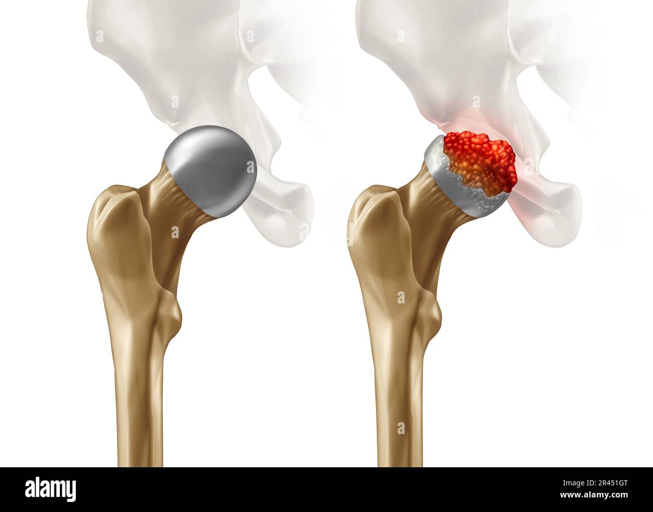 Femoral Head Disease and osteonecrosis or avascular necrosis and aseptic necrosis with a healthy hip compared to an osteoarthritis damaged pelvic join Stock Photo