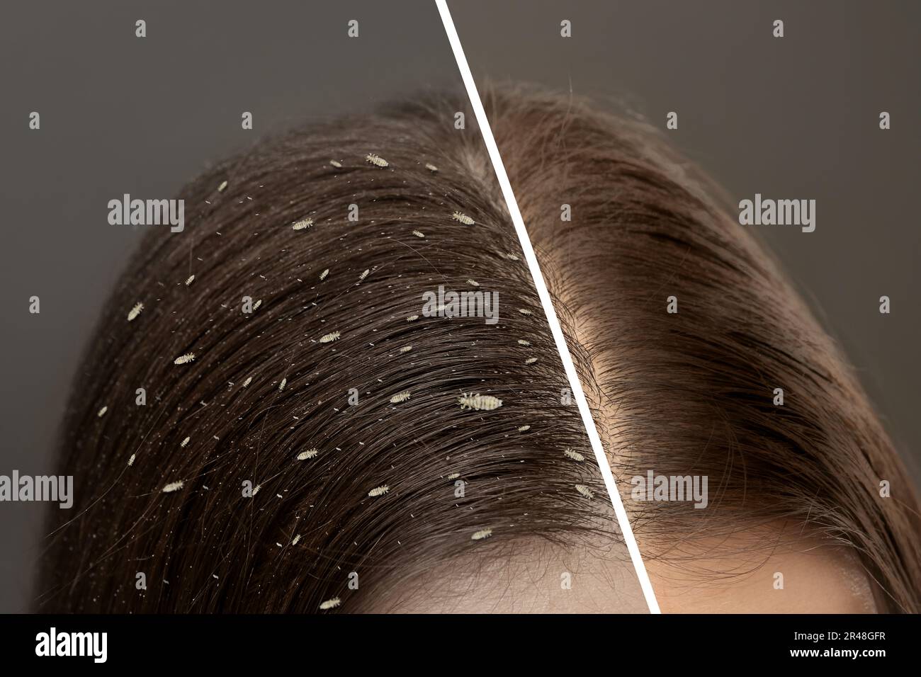 Collage showing woman's hair before and after lice treatment on grey background, closeup. Suffering from pediculosis Stock Photo