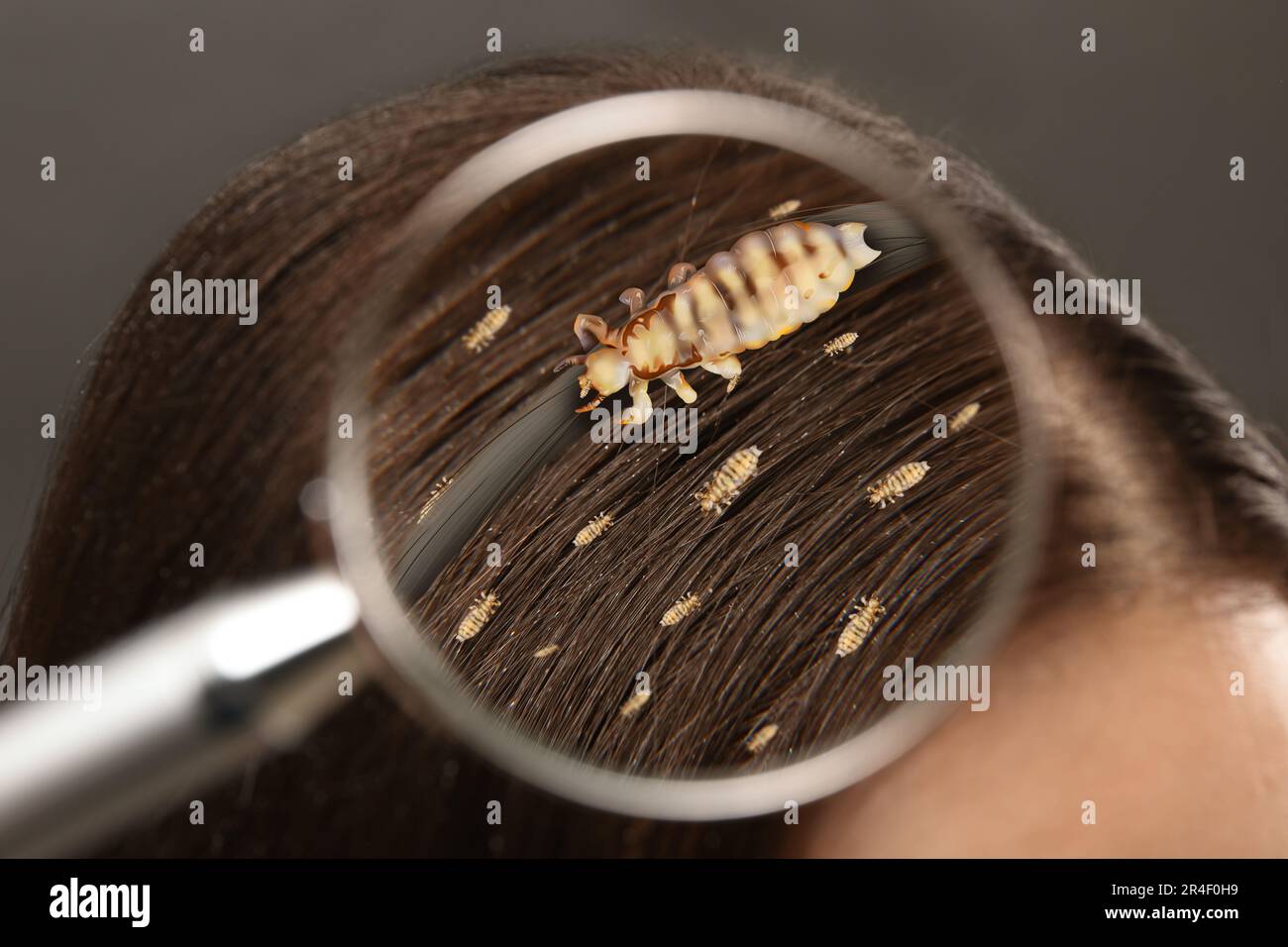Pediculosis. Woman with lice and nits, closeup. View through magnifying