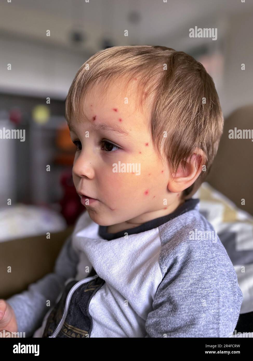 Chickenpox bubble rash on child face. Sick child with chickenpox Stock Photo Alamy