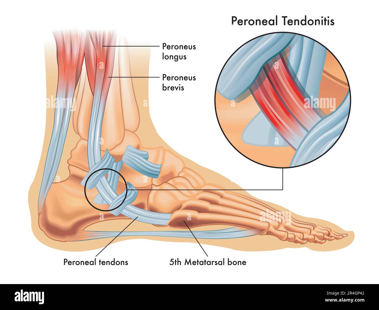 Medical illustrations of symptoms of peroneal tendonitis, with enlargement of the affected area, with annotations. Stock Photo