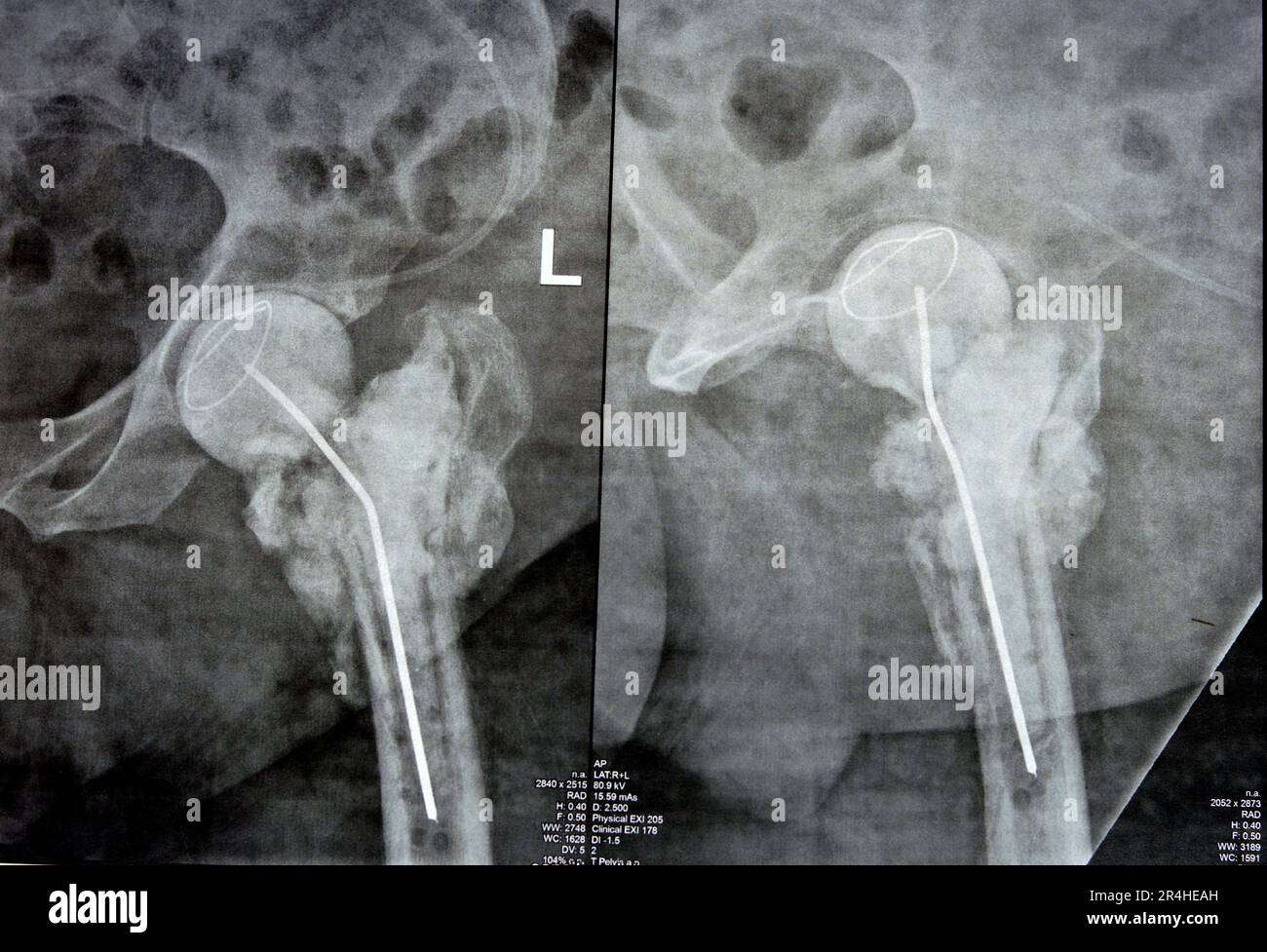 Plain X ray hip joint show left trans cervical fracture of the head of femur with temporary antibiotic loader spacer antibiotic-loaded bone cement aft Stock Photo