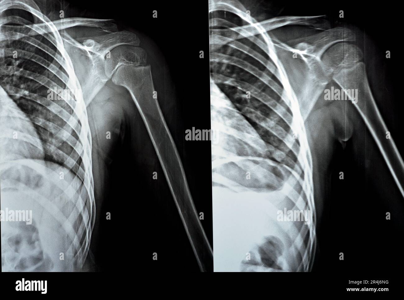 Lateral scapula x ray hi-res stock photography and images - Alamy