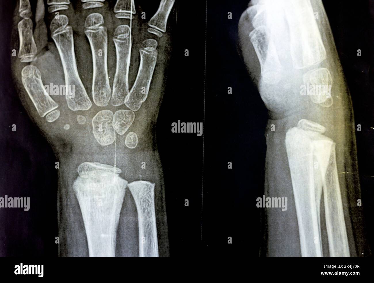 A PXR plain x ray of right wrist joint of skeletally immature female child patient shows neglected physeal injury of right distal radius bone, Injury Stock Photo