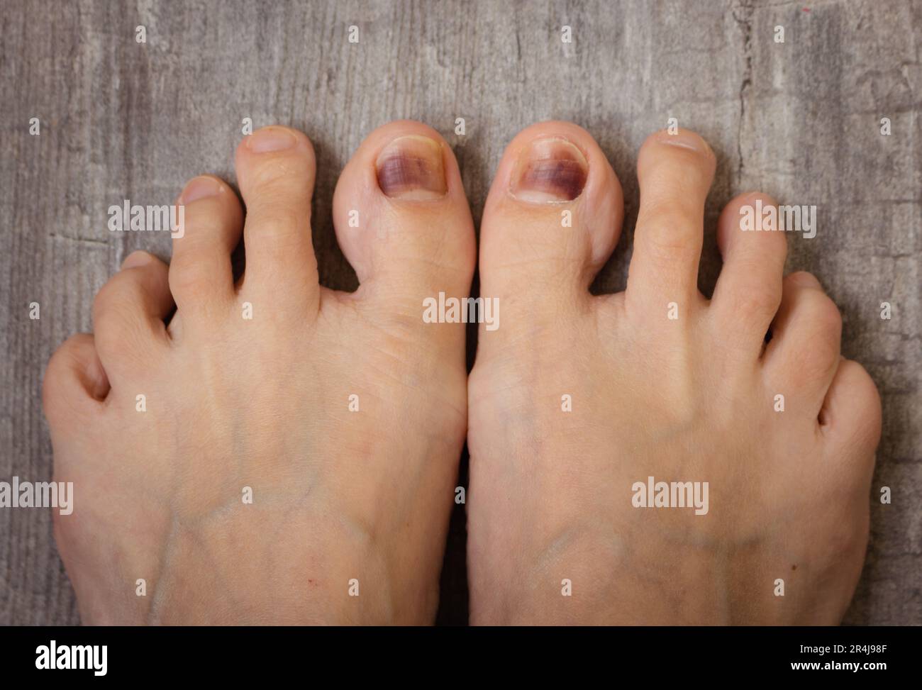 Feet on the floor. Damaged nails. Bruise under thumb nail. Barefoot