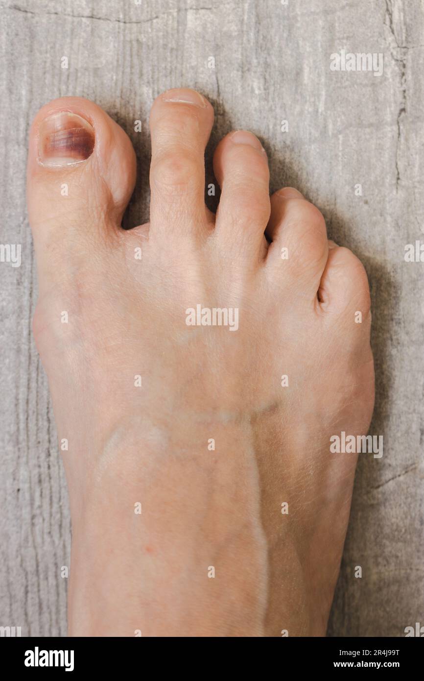 Right foot on the floor. Damaged nail. Bruise under thumb nail