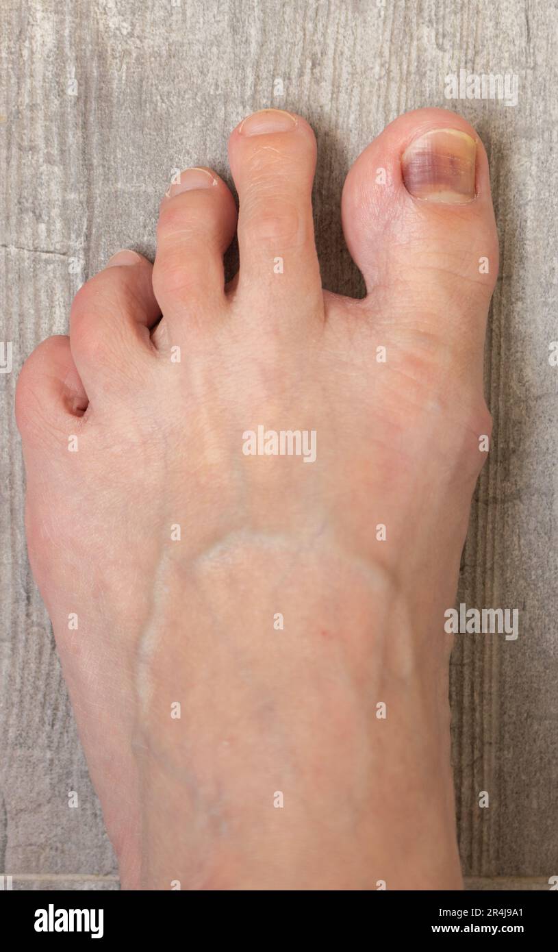 Left foot on the floor. Damaged nail. Bruise under thumb nail. Barefoot